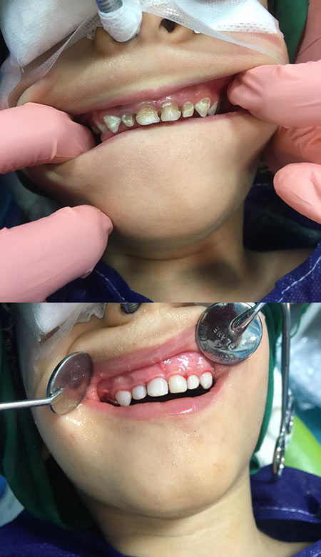 بیهوشی کودکان برای دندانپزشکی,بیهوشی کودکان برای ترمیم دندان