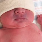 سیانوز در نوزادان چیست؟ عوامل و درمان سیانوز