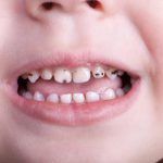 علت سیاه شدن دندان کودکان و راههای پیشگیری از آن