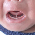 علت چسبیدن زبان به کف دهان در نوزادان چیست؟
